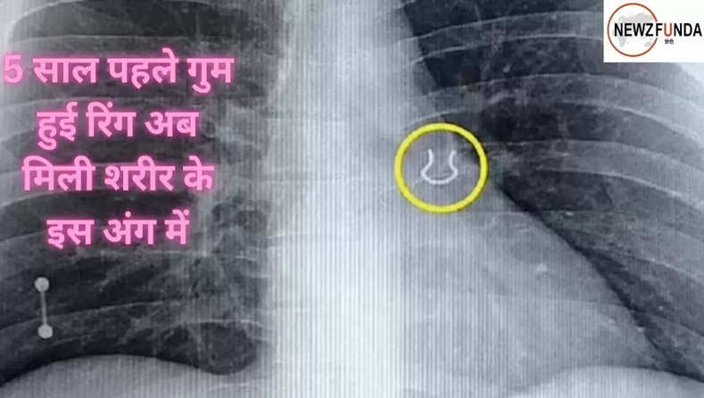 Ajab-Gajab: 5 साल पहले गुम हुई रिंग अब मिली शरीर के इस अंग में, X-ray के जरिए लगा पता 